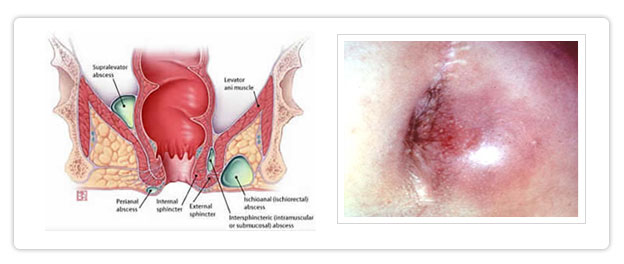 Boils: Facts About Treatments, Home Remedies, and Causes