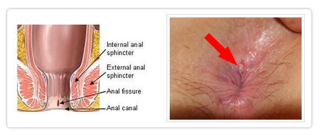 Genital Herpes - symptoms, management and treatment